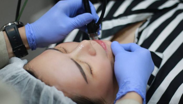 Miracle Aesthetic Clinic Optimalkan Teknologi Peeling Binafsi untuk Mengatasi Hiperpigmentasi Kulit